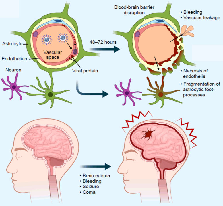 Patogenesi IAE con edema cerebrale grave causato da IAV