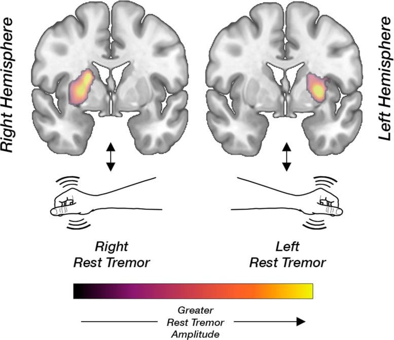 Illustrazione dell'associazione tra tremore a riposo e funzione dopaminergica cerebrale