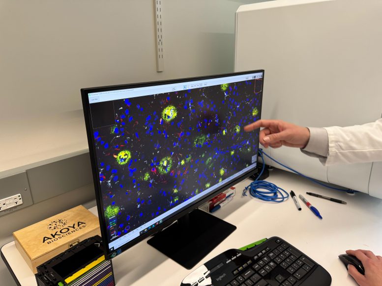 Image of a Treated Brain With Alzheimer&rsquo;s Disease
