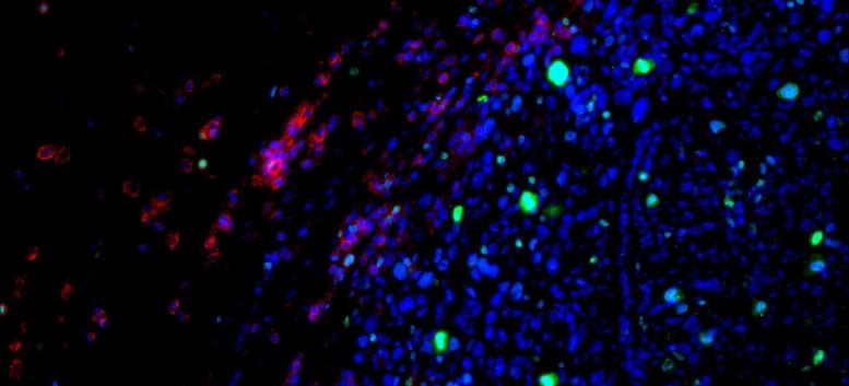 Immune Cells Accumulating and Dividing Within Tumor