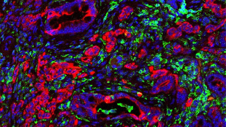 Immune Cells Infiltrating Colorectal Cancer Tumors