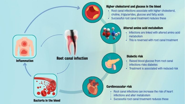 Infographic on Root Canal Infections and Systemic Health Risks