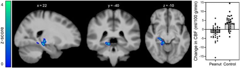 Insulin Induced Changes in Regional Cerebral Blood Flow