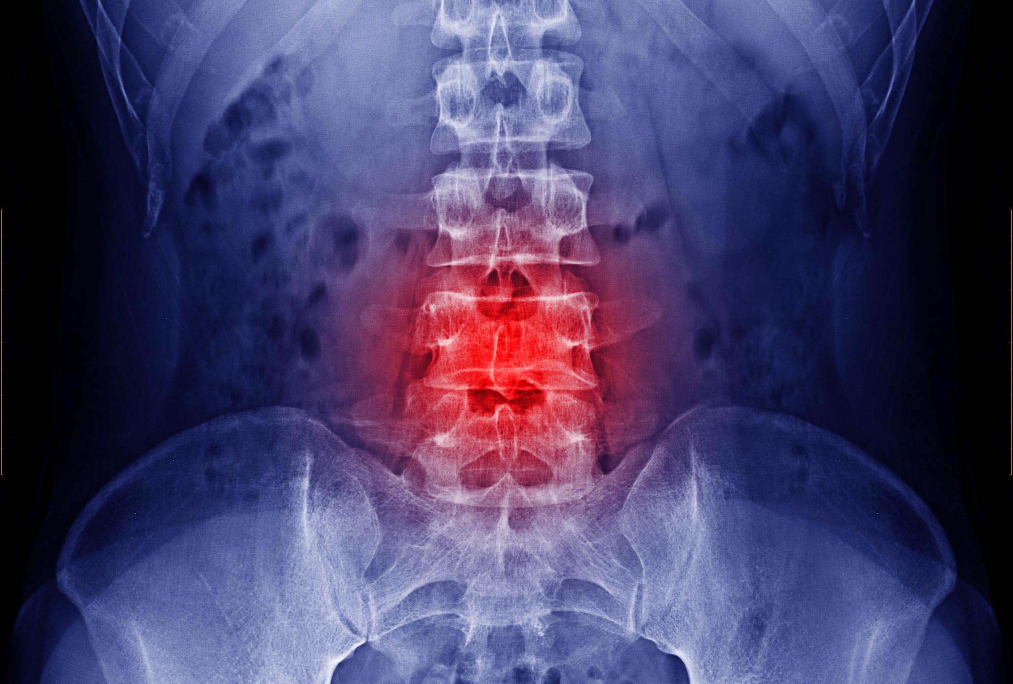 Intervertebral Lumbar Spine