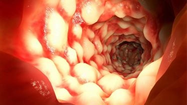 Intestine Crohn’s Disease