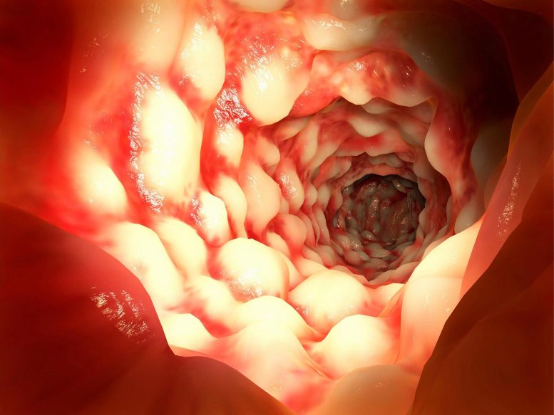 Intestine Crohn’s Disease