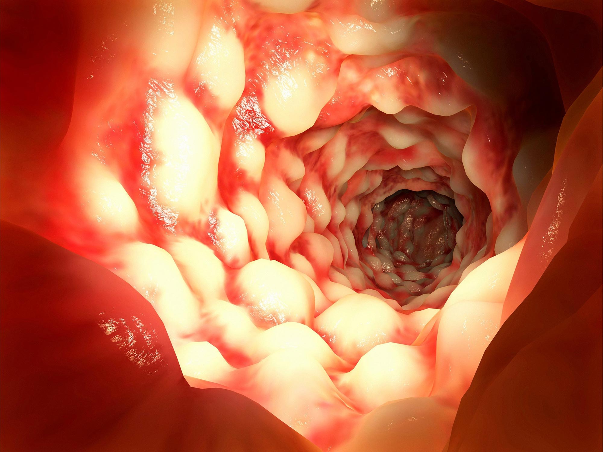 Intestinal Crohn's disease