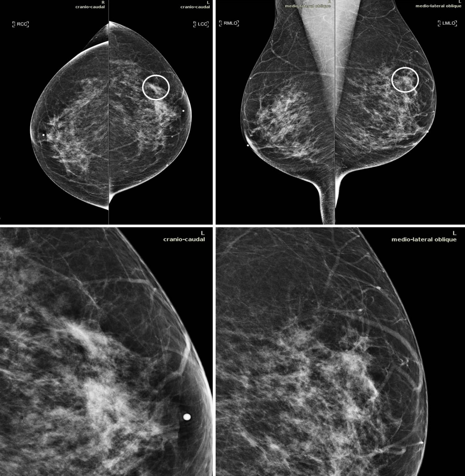 Invasive Ductal Carcinoma Mammograms 1502x1536 
