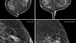 Invasive Ductal Carcinoma Mammograms