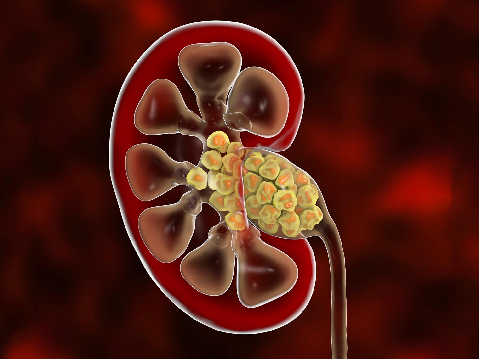 kidney stone illustration