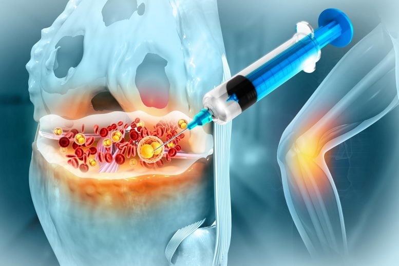 Knee Joint Injection Platelet Rich Plasma Osteoarthritis