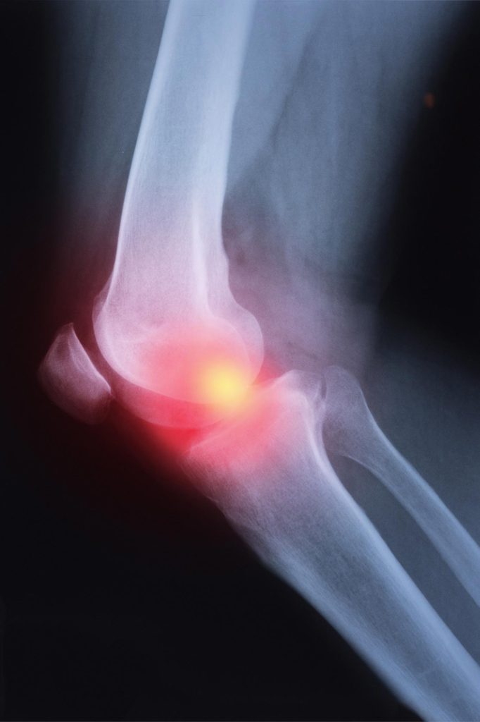 Knee Pain Arthritis X ray