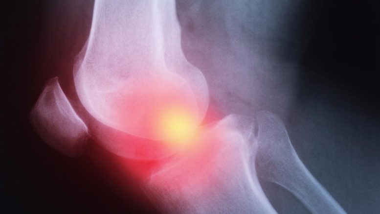Osteoarthritis Breakthrough New Therapeutic Approach Discovered