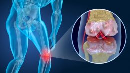 Knee Pain Concept