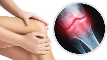 Blood Test Detects Knee Osteoarthritis 8 Years Before X-Rays