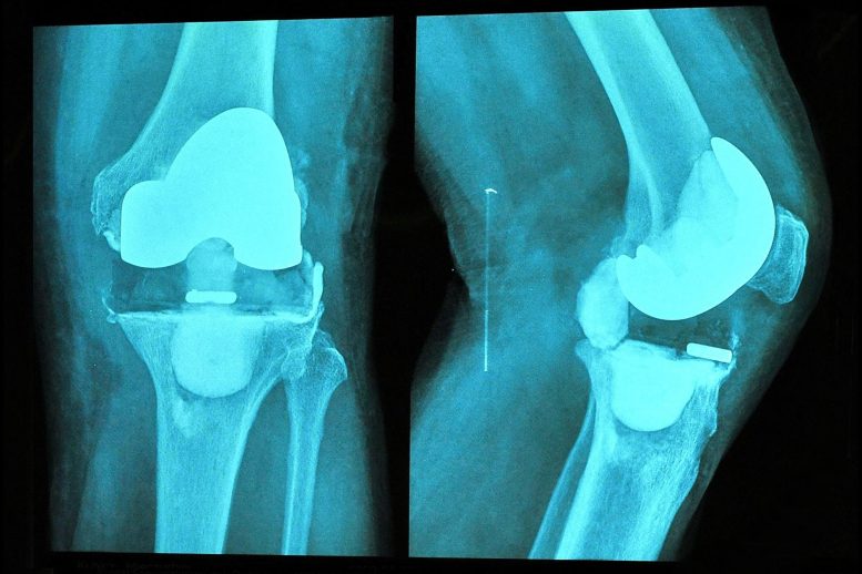 Knee Replacement Surgery X-Ray