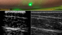 Laser Ultrasound Images of Humans