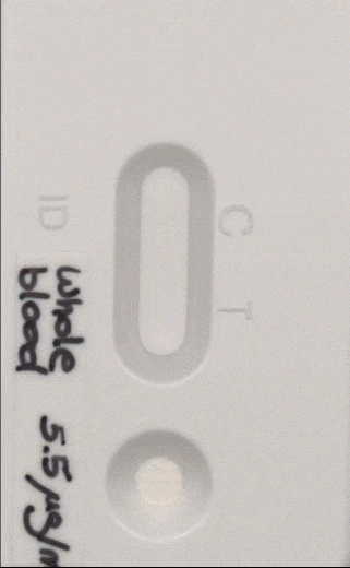 Lateral Flow Assay for Calprotectin