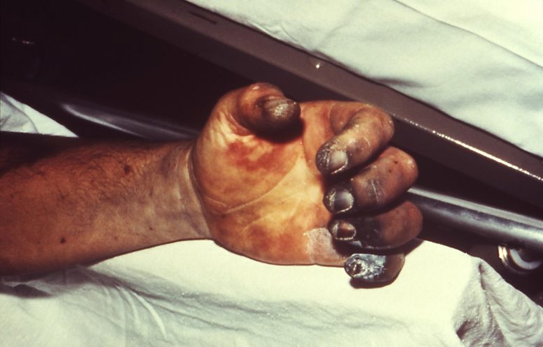 Left Hand of Plague Victim