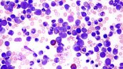 Leukemia Blood Smear