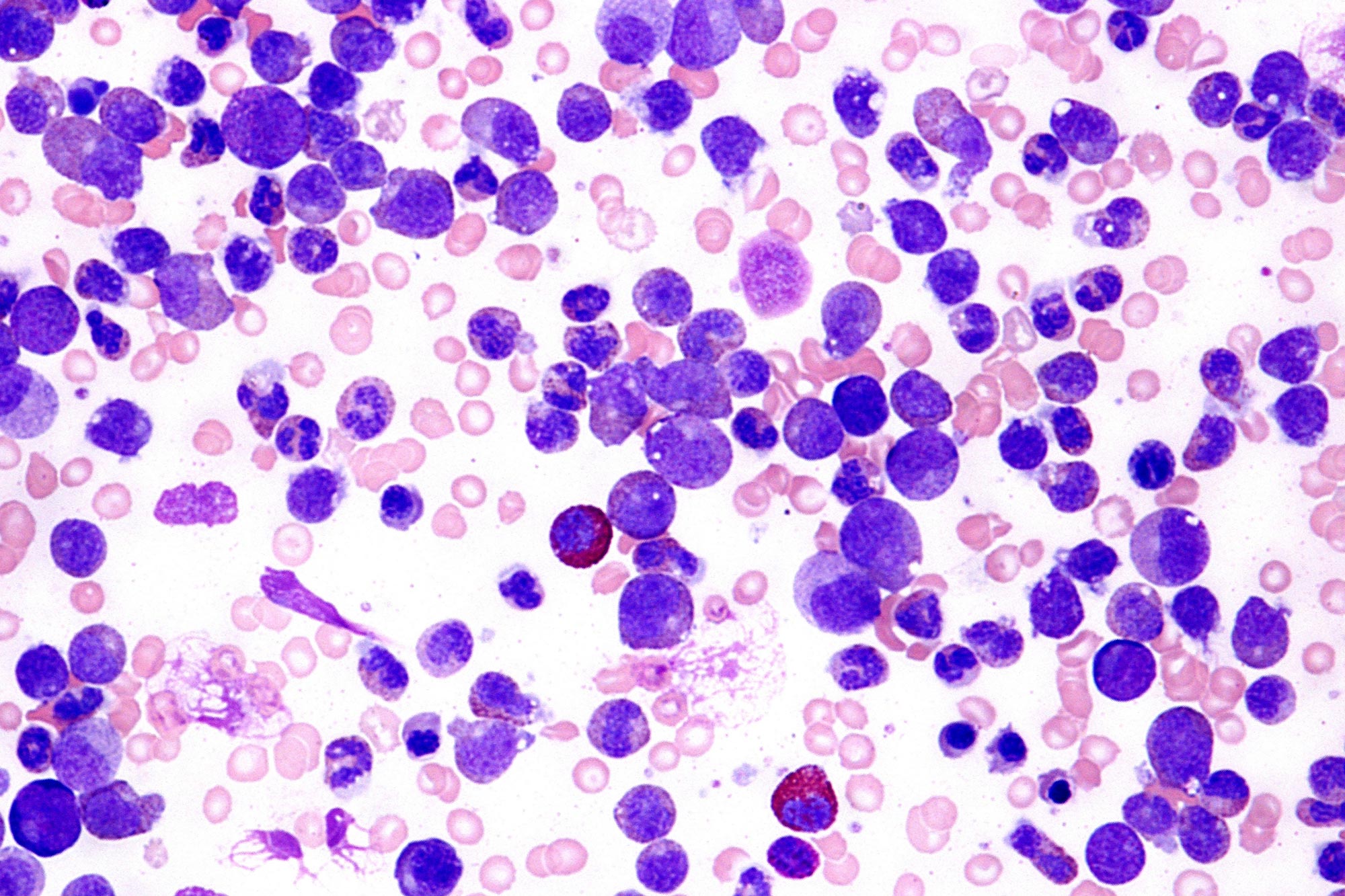 acute leukemia cells