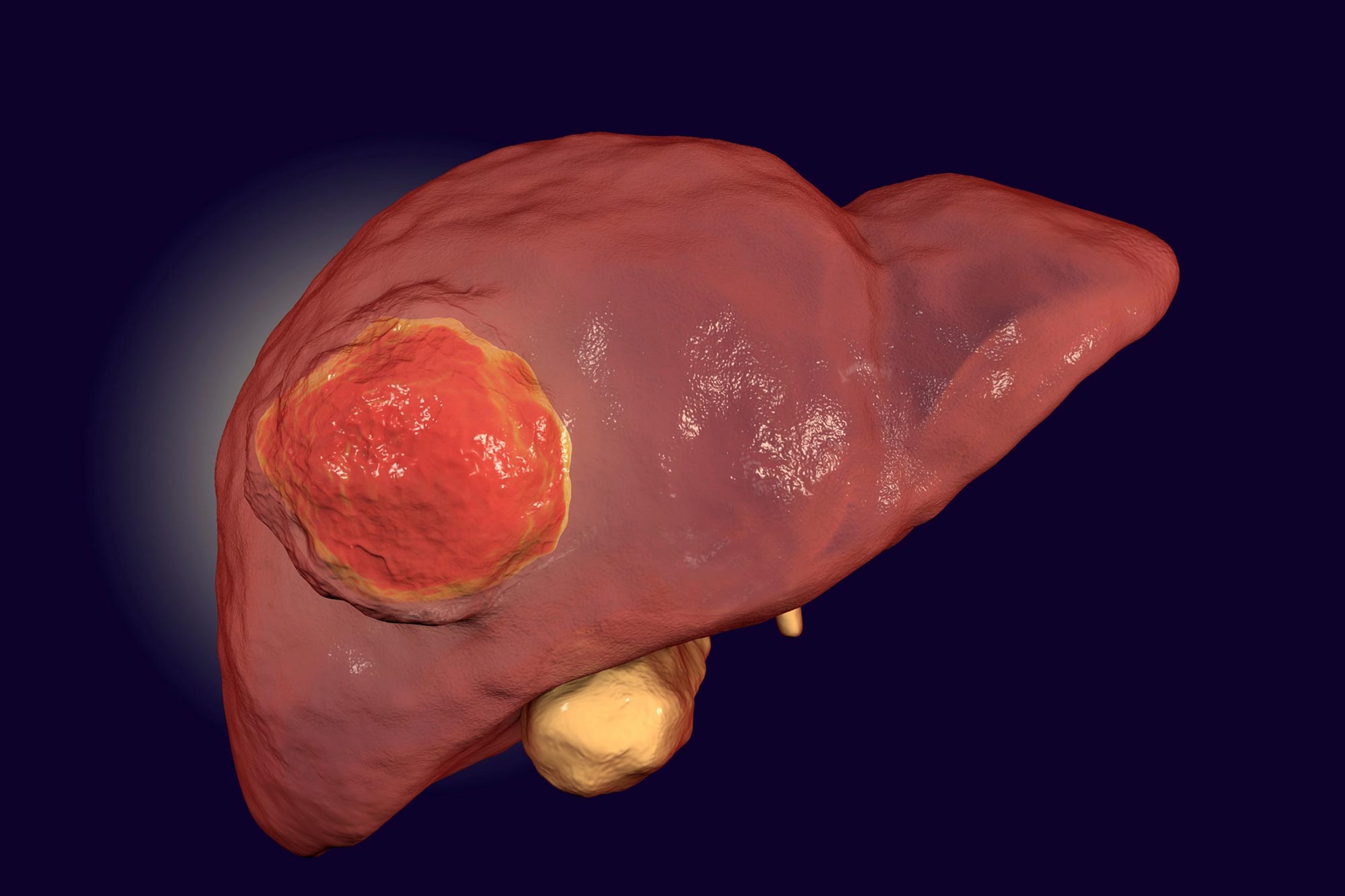 肝癌的射频消融治疗及围手术期的处理---危险部位肝癌RFA治疗