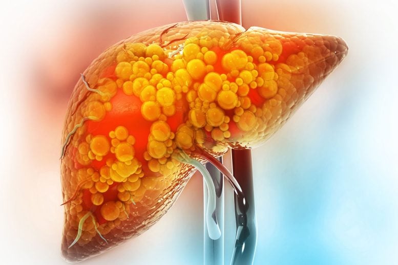 Liver Disease