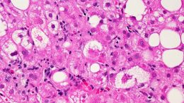 Liver Tissue Affected by Non-Alcoholic Fatty Liver Disease