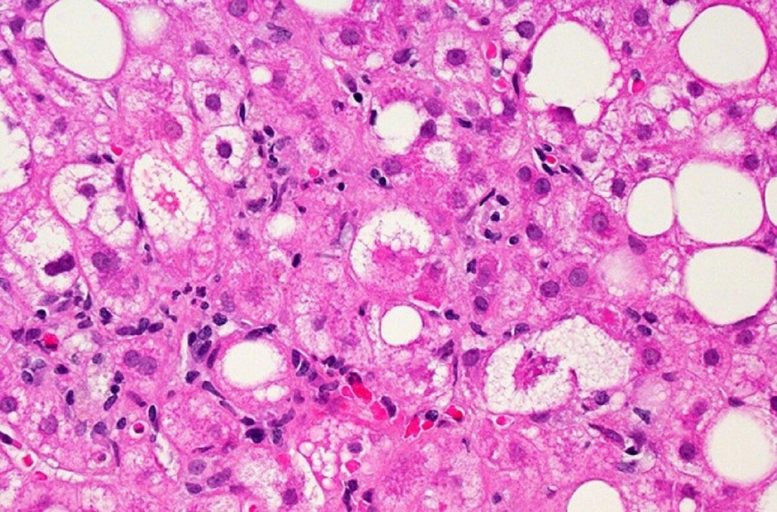 Liver Tissue Affected by Non-Alcoholic Fatty Liver Disease