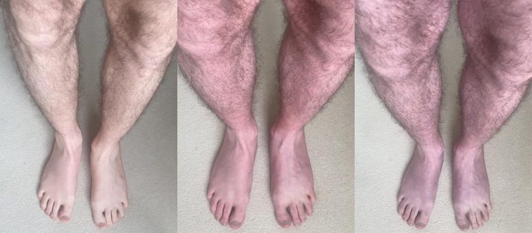 Long COVID ‘Blue Legs’ Symptom