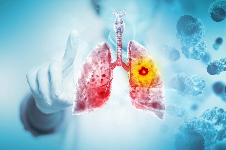 Lung Cancer Bronchial Carcinoma Medical Treatment