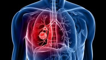 Lung Cancer Illustration