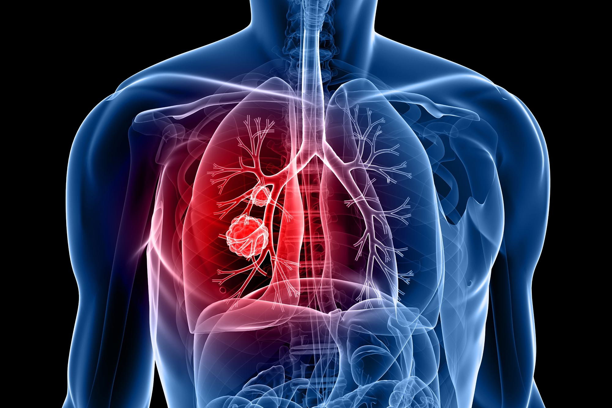 Lung Cancer Illustration