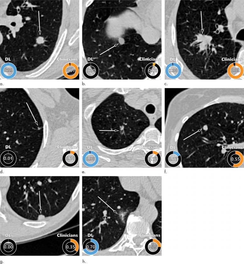 Lung Cancer Nodules CT Images