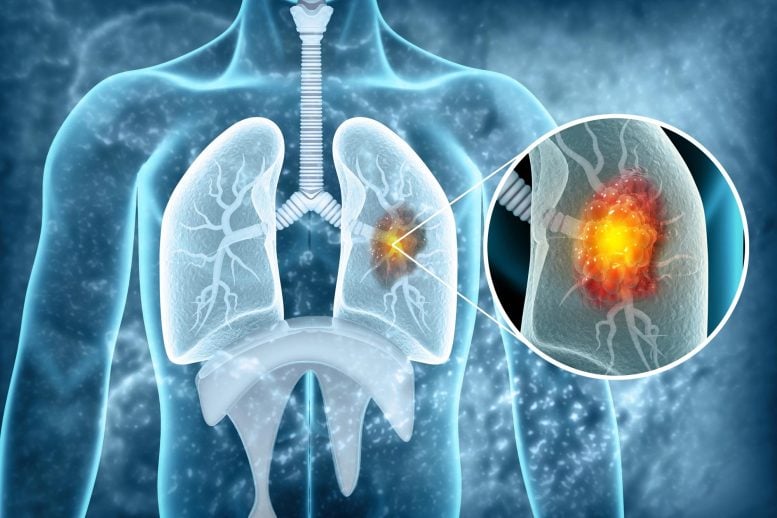 Lung Cancer Tumor Disease