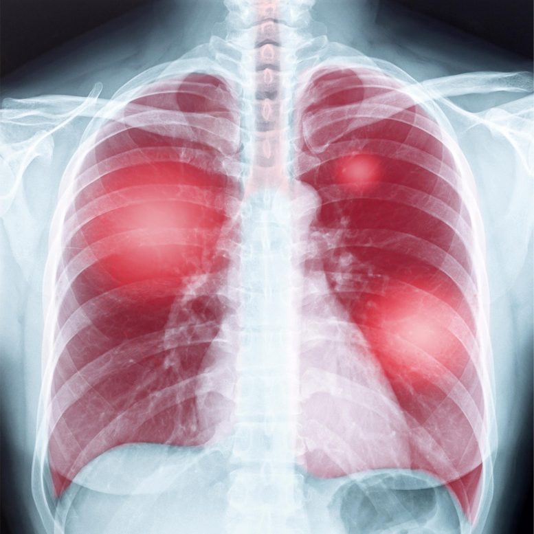 Lung Disease Chest X-ray