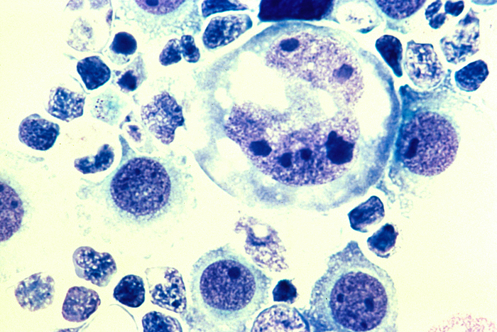 Lymphoma Tumor Cells