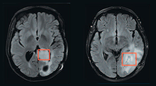 MR Spectroscopy Helps Measure Brain Tumor Mutation