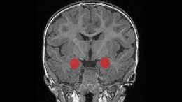 MRI Amygdala Baby Autism