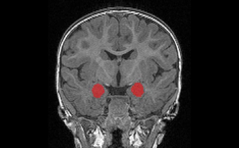 MRI Amygdala Baby Autism