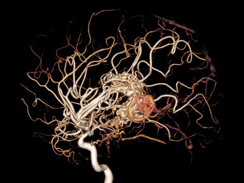 MRI Brain Arteries