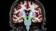 MRI Brain Image