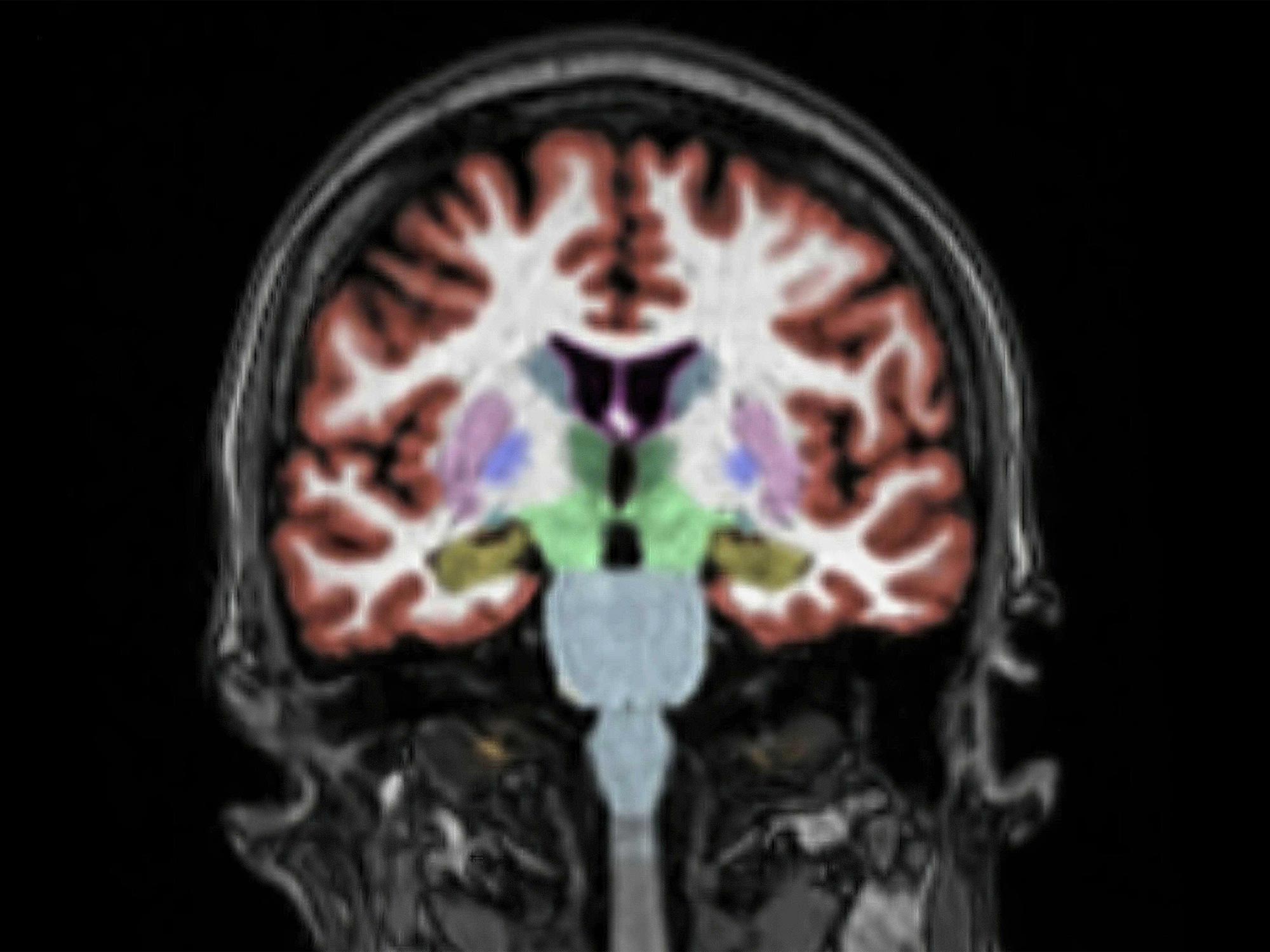 Imagen del cerebro de resonancia magnética