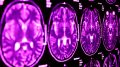 MRI Brain Scan