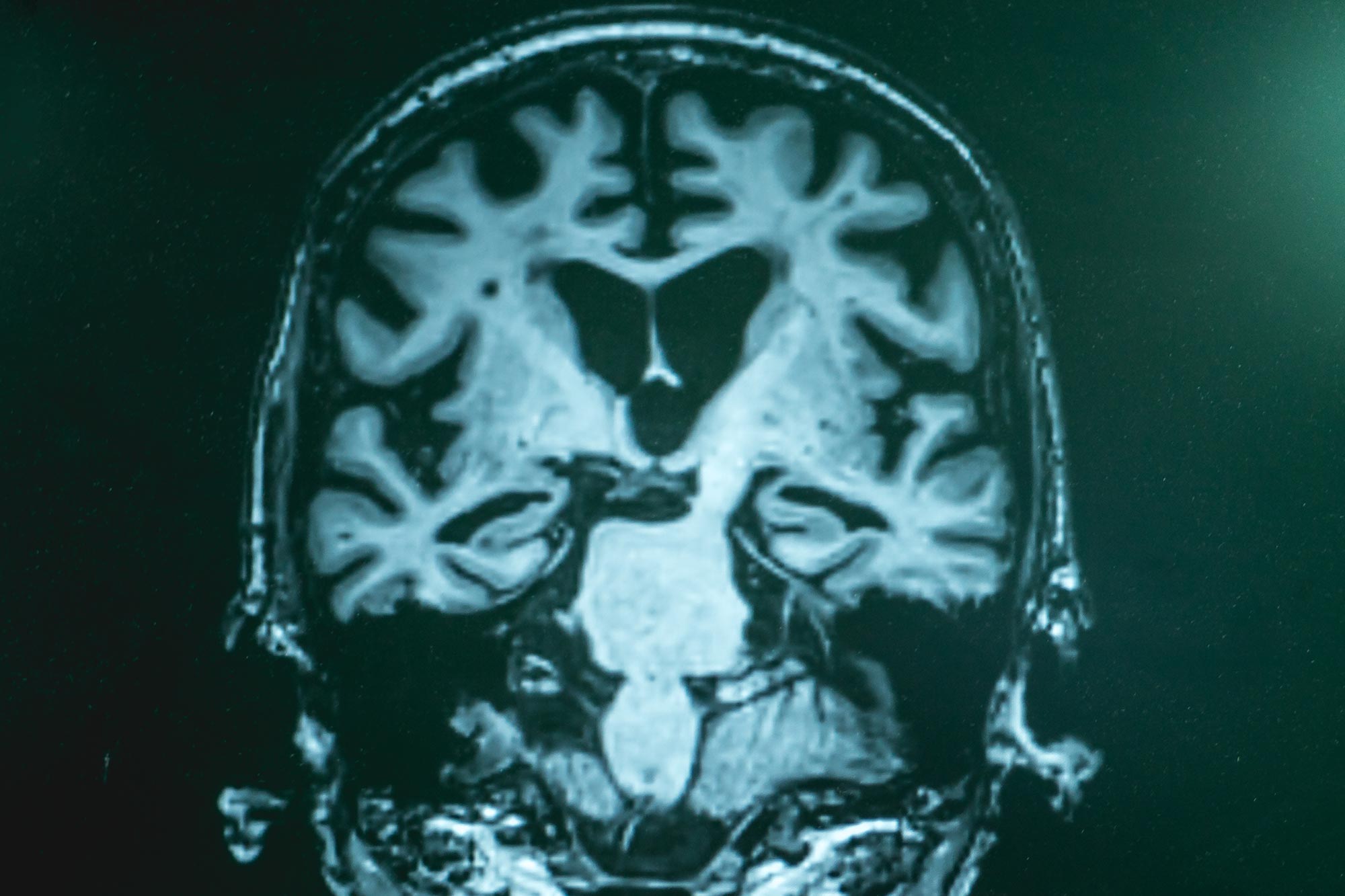 Beyond Amyloid Plaques: Scientists Reveal Broader Chemical Disruptions in Alzheimer’s