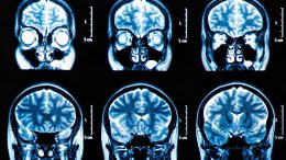 MRI Brain Scan Images