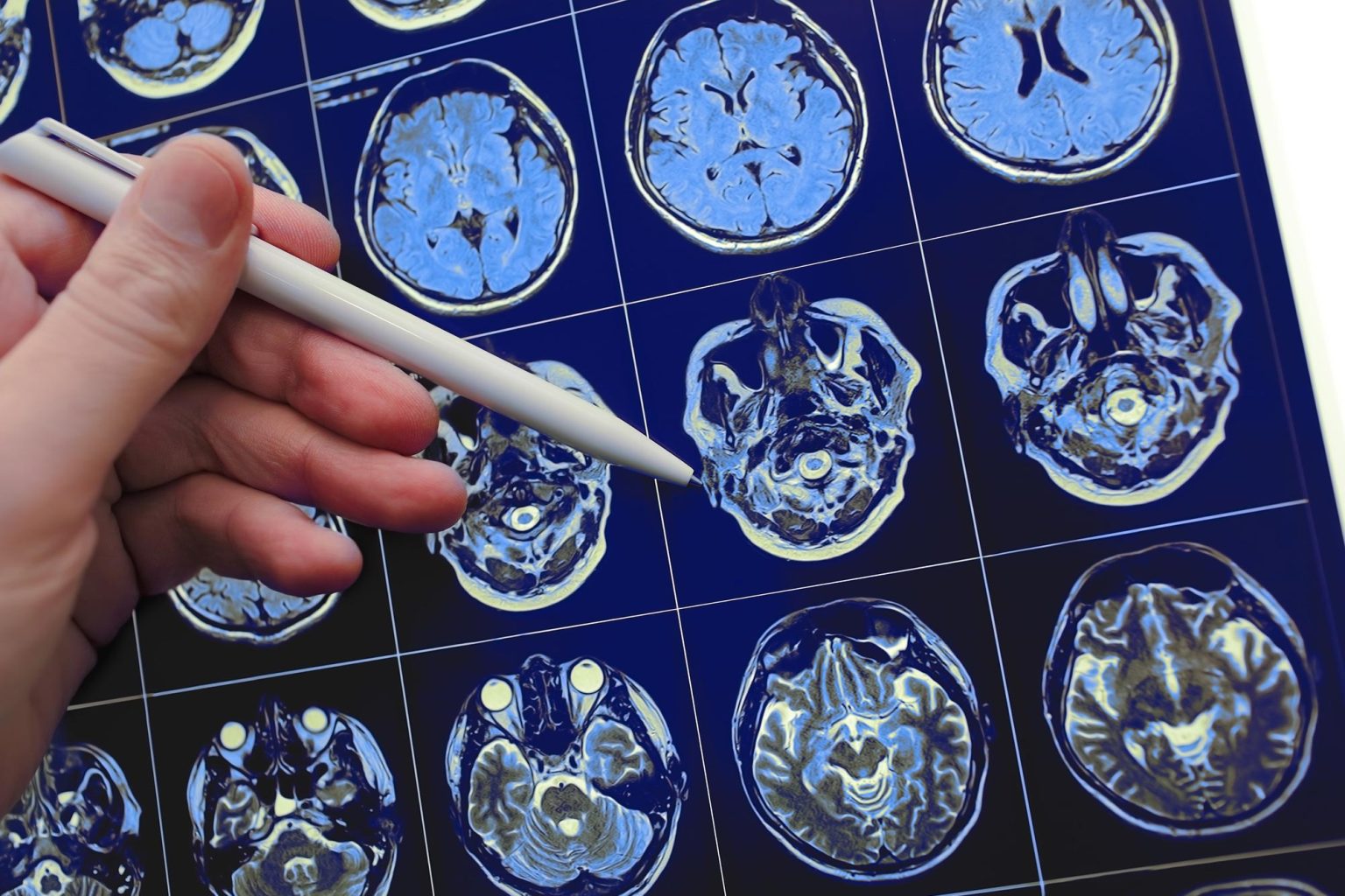 New Study Links Chronic Insomnia To Accelerated Brain Aging - yxv4x7b