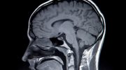 MRI Brain Scan Profile