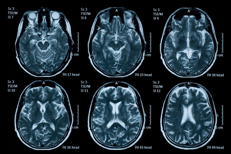 MRI Beyin Taramaları
