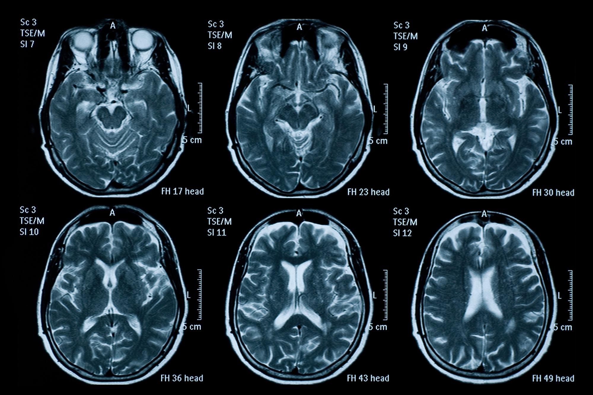 Brain Damage Higher Over Short Term in COVID-19 Patients Than in Alzheimer’s Patients thumbnail